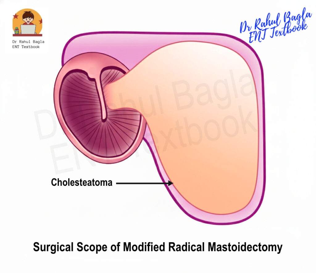 Surgical Scope of Modified Radical Mastoidectomy Dr Rahul Bagla ENT Textbook