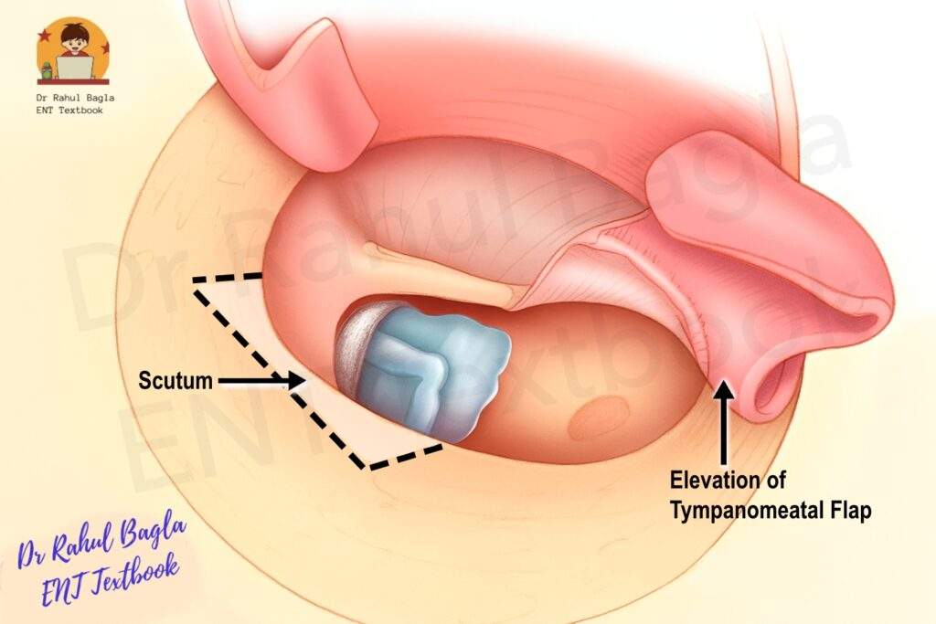 TM Flap elevation and Scutum Removed Dr Rahul Bagla ENT Textbook
