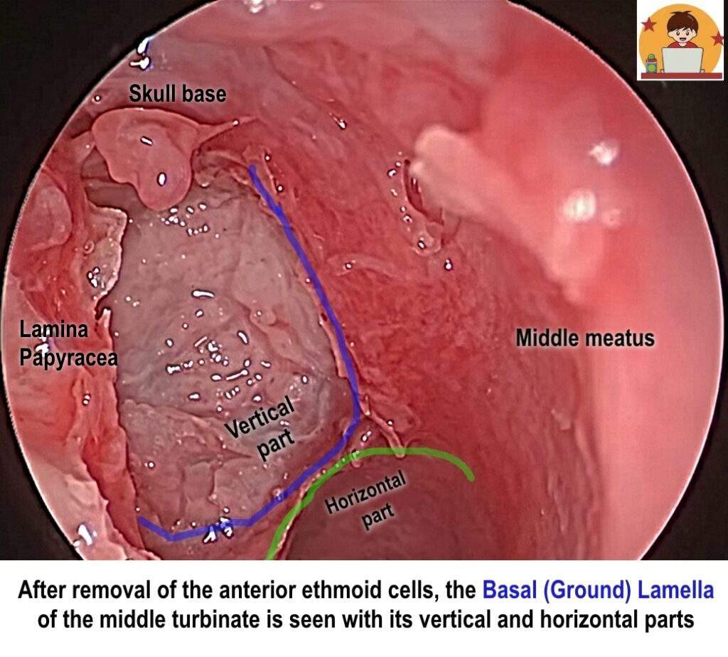 After-removal-of-the-anterior-ethmoid-cells-the-Basal-Ground-Lamella-of-the-middle-turbinate