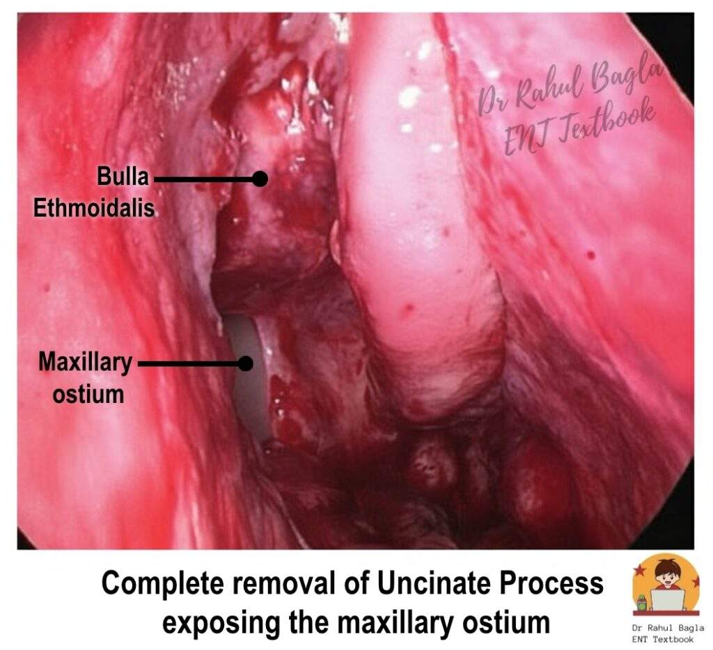 Complete removal of Uncinate FESS - Uncinate Process - Process exposing the maxillary ostium