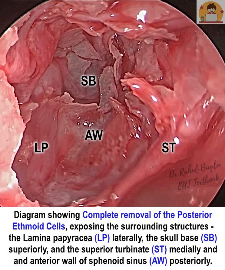 Diagram showing Complete removal of the Posterior Ethmoid Cells, exposing the surrounding structures - the Lamina papyracea (LP) laterally, the skull base (SB) superiorly, and the superior turbinate (ST) medially and and anterior wall of sphenoid sinus (AW) posteriorly.