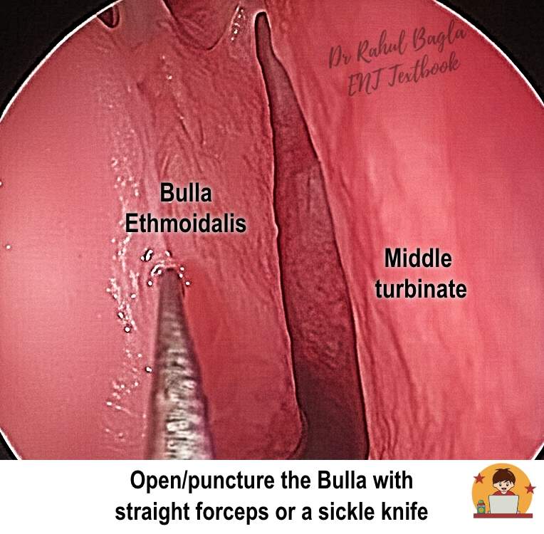 FESS - Open_puncture the Bulla with straight forceps or a sickle knife