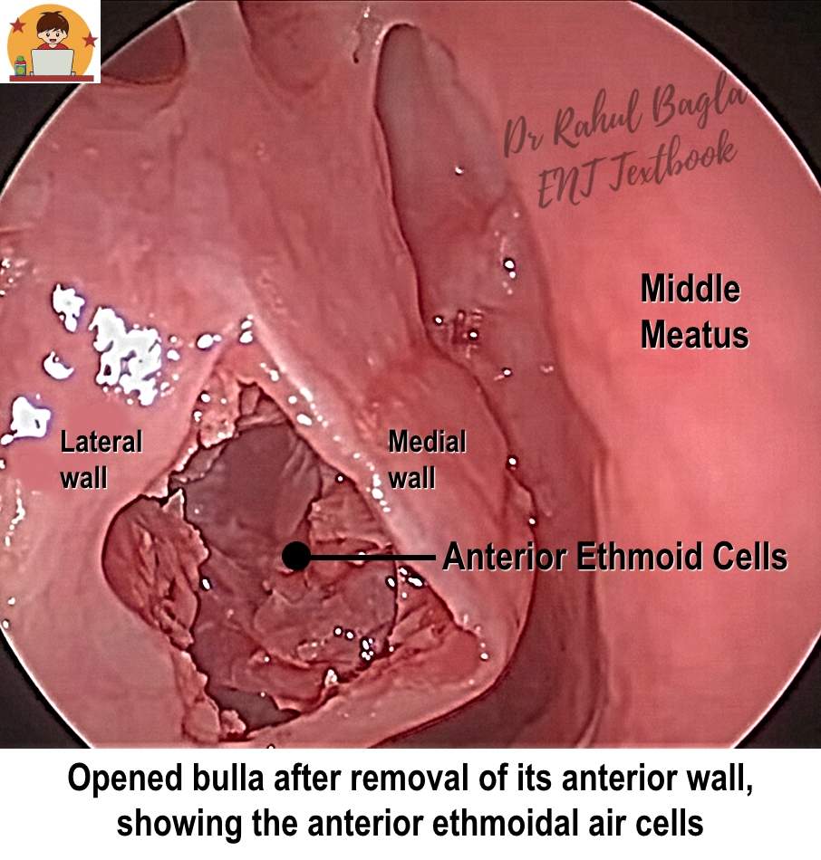 FESS - Opened Bulla Ethmoidalis Dr Rahul Bagla ENT Textbook