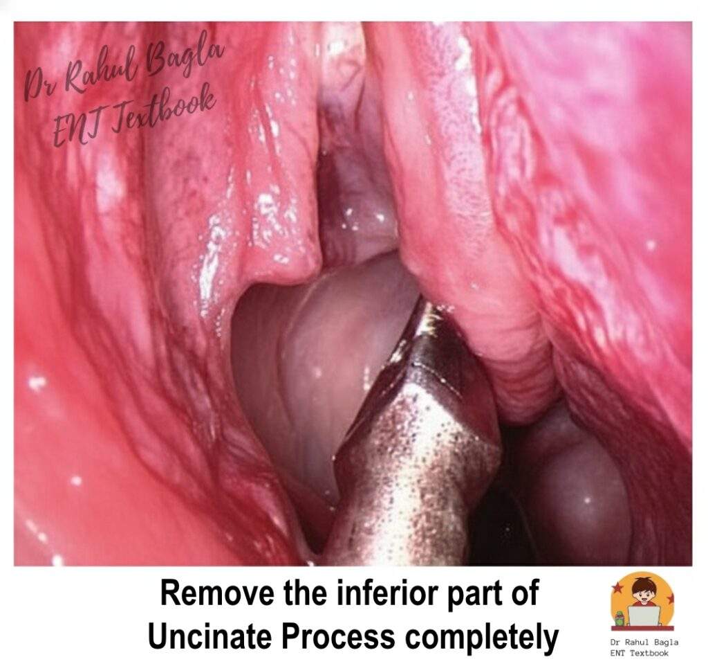 FESS - Uncinate Process - Remove the inferior part of Uncinate Process completely