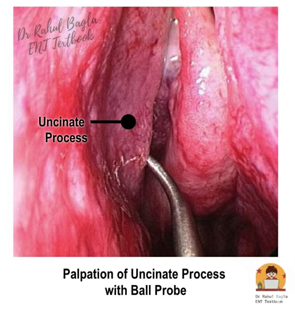 Palpation of uncinate process with ball probe