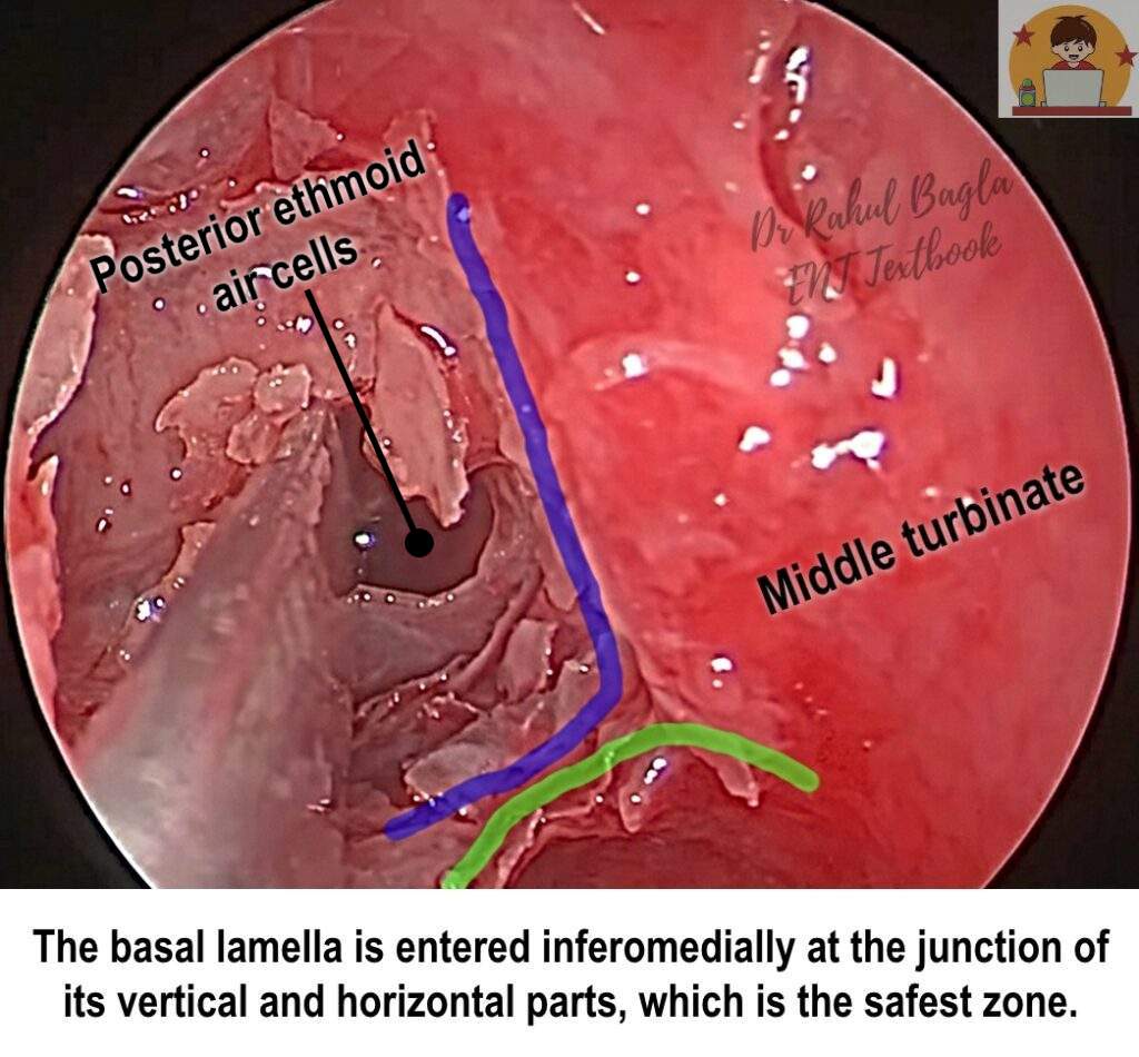 The-basal-lamella-is-entered-inferomedially-at-the-junction-of-its-vertical-and-horizontal-parts-1024x950