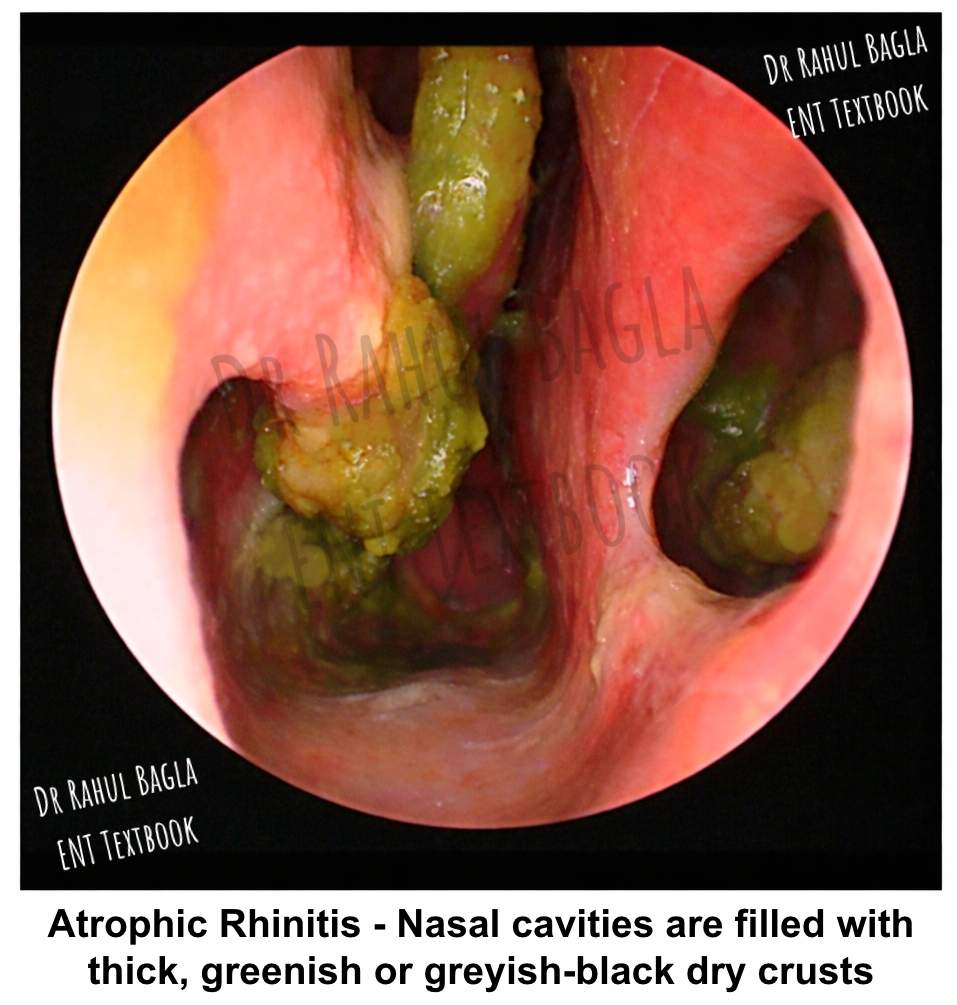 Atrophic Rhinitis Dr Rahul Bagla ENT Textbook