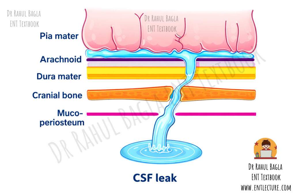 Cerebrospinal Fluid (CSF) Rhinorrhoea Leak Dr Rahul Bagla ENT Textbook