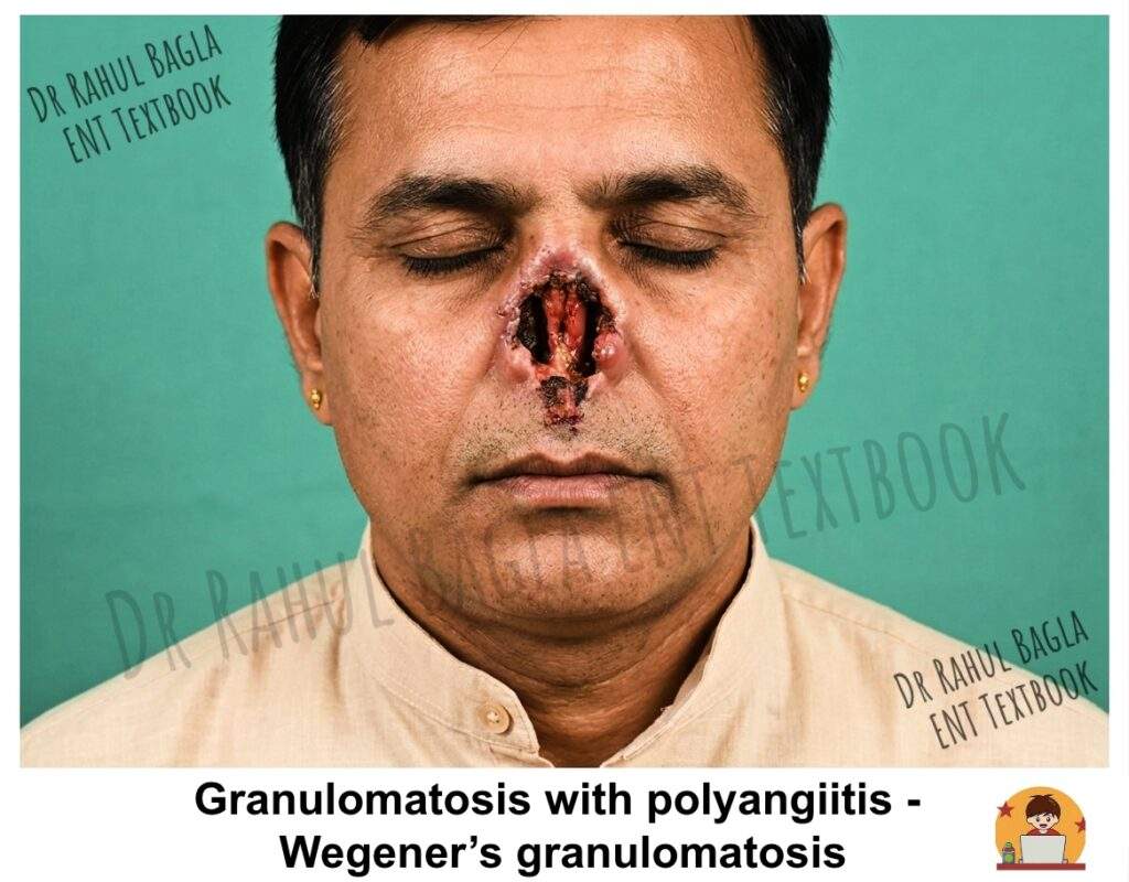 Granulomatosis with polyangiitis - Wegener’s granulomatosis Dr Rahul Bagla ENT Textbook