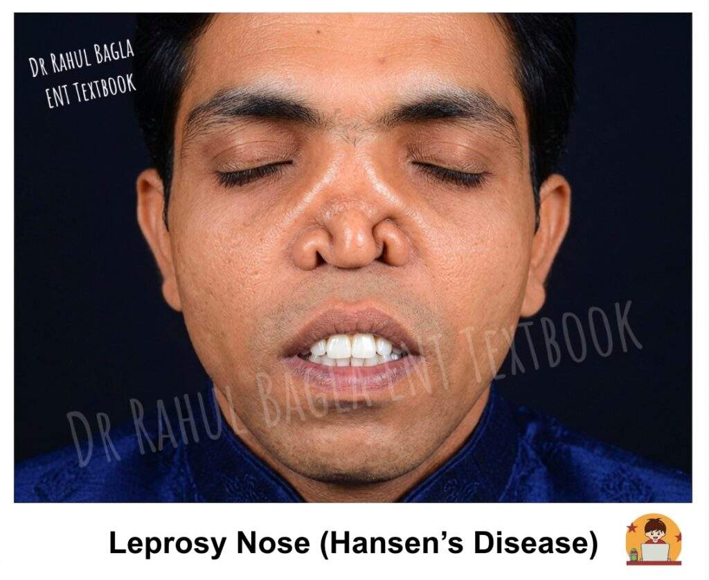 Leprosy Nose (Hansen’s Disease) Dr Rahul Bagla ENT Textbook