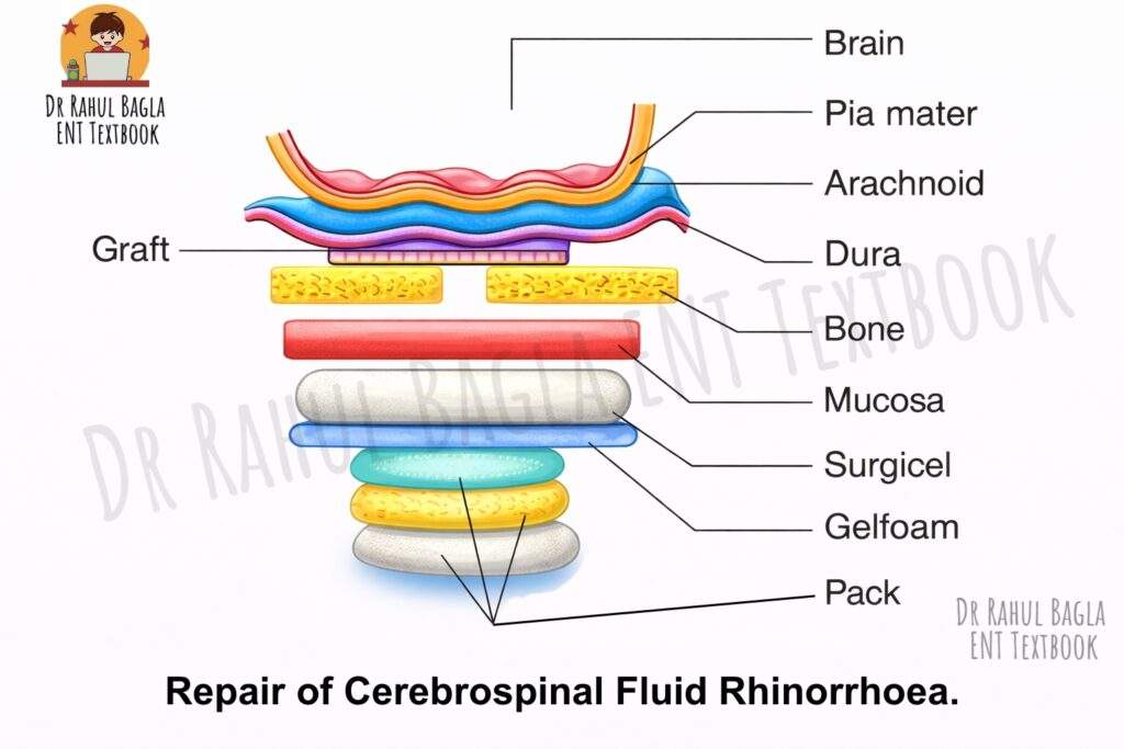 Repair of Cerebrospinal Fluid Rhinorrhoea Leak Dr Rahul Bagla ENT Textbook