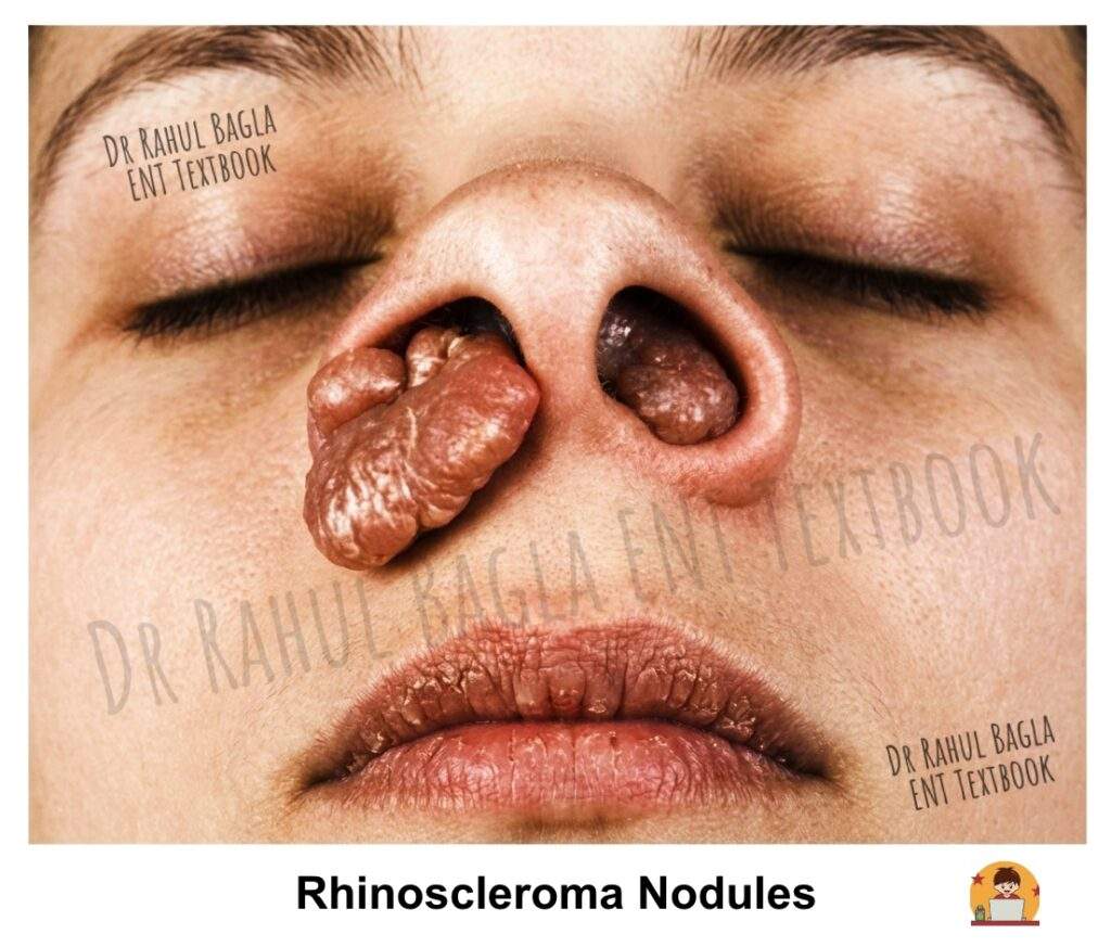 Rhinoscleroma Nodules Dr Rahul Bagla ENT Textbook. Multiple firm, pale pink to reddish nodules within the nasal cavity, showing irregular mucosal thickening and a granulomatous appearance, characteristic of rhinoscleroma.