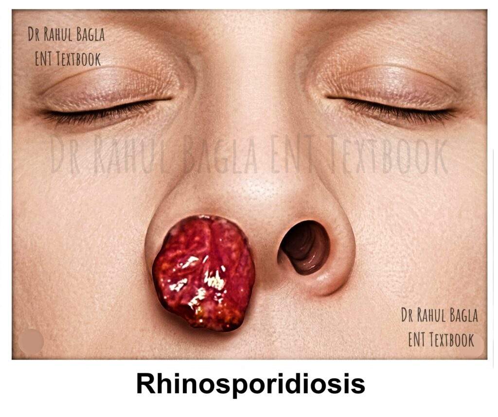 Rhinosporidiosis Dr Rahul Bagla ENT Textbook