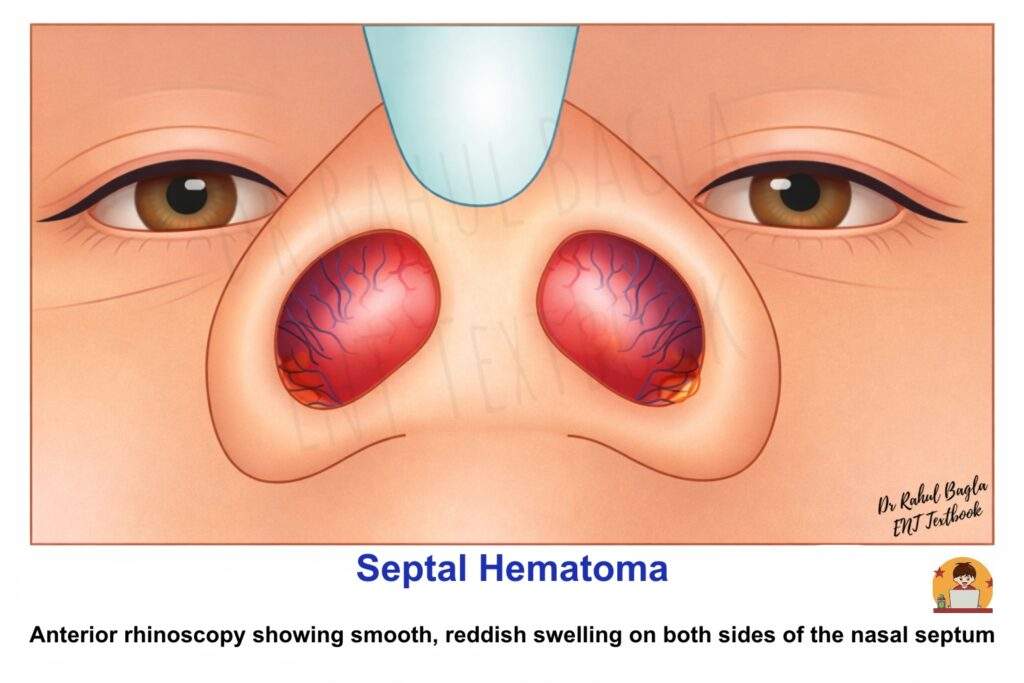 Septal Hematoma Dr Rahul Bagla ENT Textbook