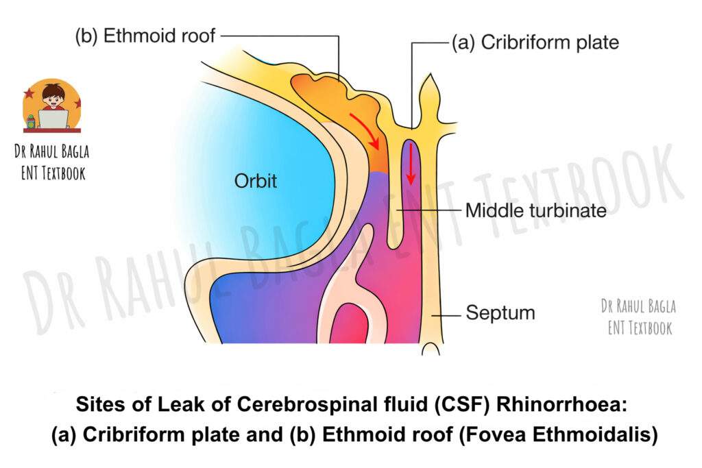 Sites of Leak of Cerebrospinal fluid (CSF) Rhinorrhoea Dr Rahul Bagla ENT Textbook
