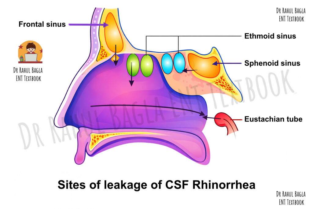 Sites of leakage of CSF Sites of leakage of CSF Sites of leakage of CSF Rhinorrhea Dr Rahul Bagla ENT TextbookDr Rahul Bagla ENT Textbook Dr Rahul Bagla ENT Textbook