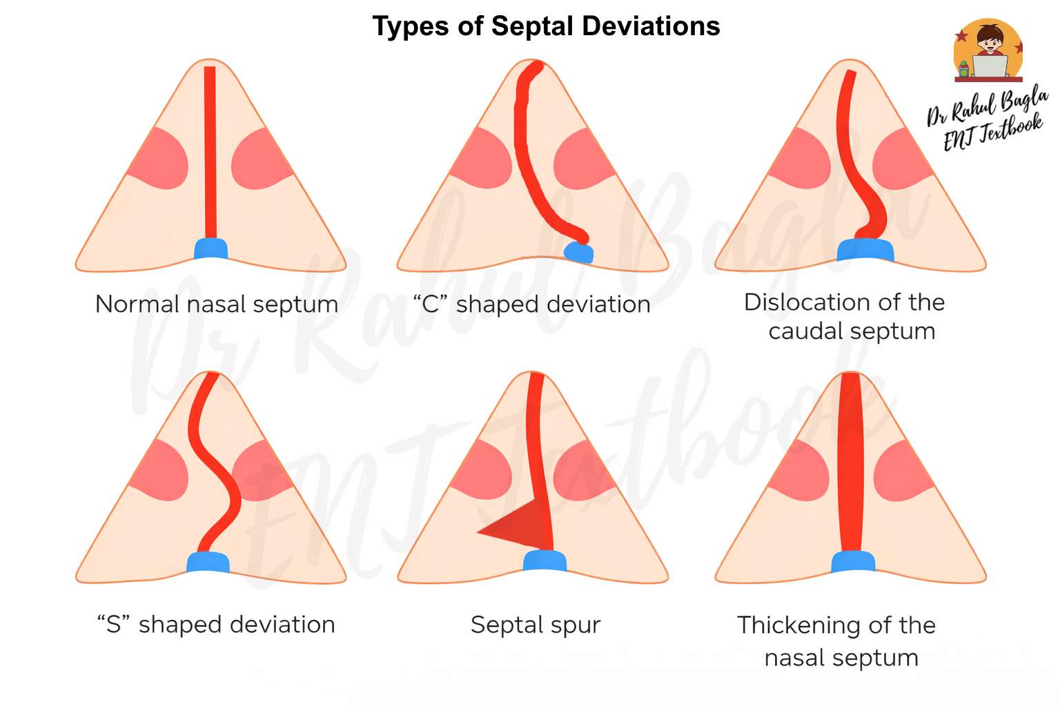 Sept Nazal Diseases of Nasal Septum - Deviated Nasal Septum (DNS), Septal hematoma ...