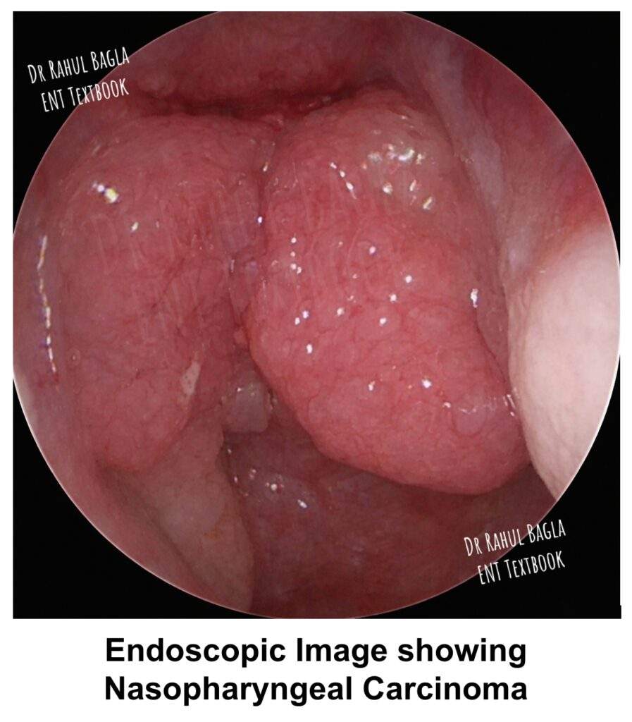 Endoscopic Image showing Nasopharyngeal Carcinoma Dr Rahul Bagla ENT Textbook