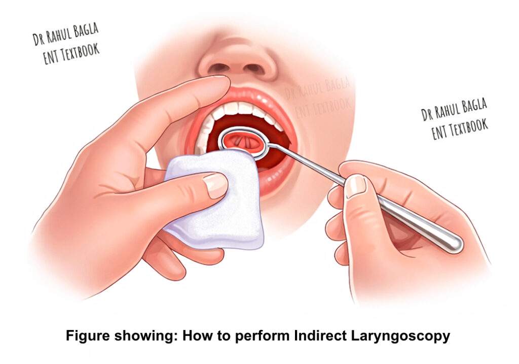 How to perform Indirect Laryngoscopy Dr Rahul Bagla ENT Textbook