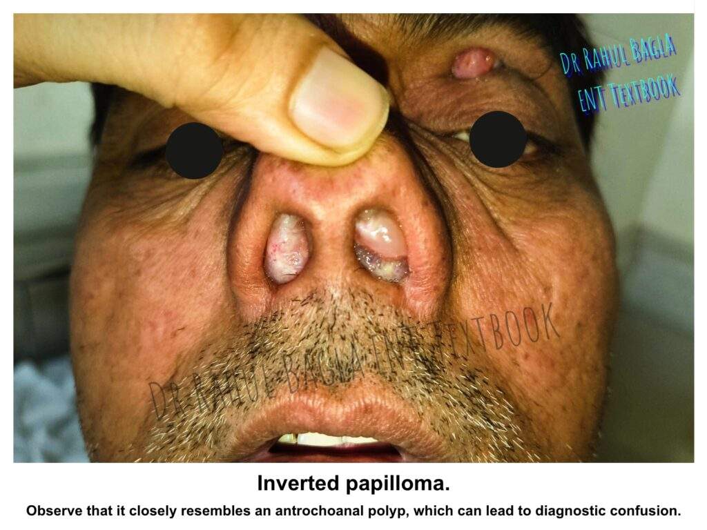 Inverted papilloma. Observe that it closely resembles an antrochoanal polyp