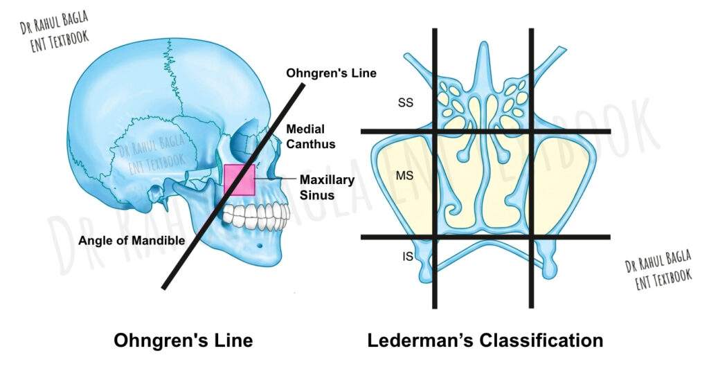 Ohngren's Line Lederman’s Classification Dr Rahul Bagla ENT Textbook