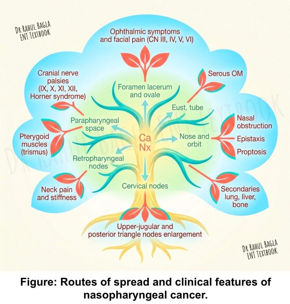 Routes of spread and clinical features of nasopharyngeal cancer