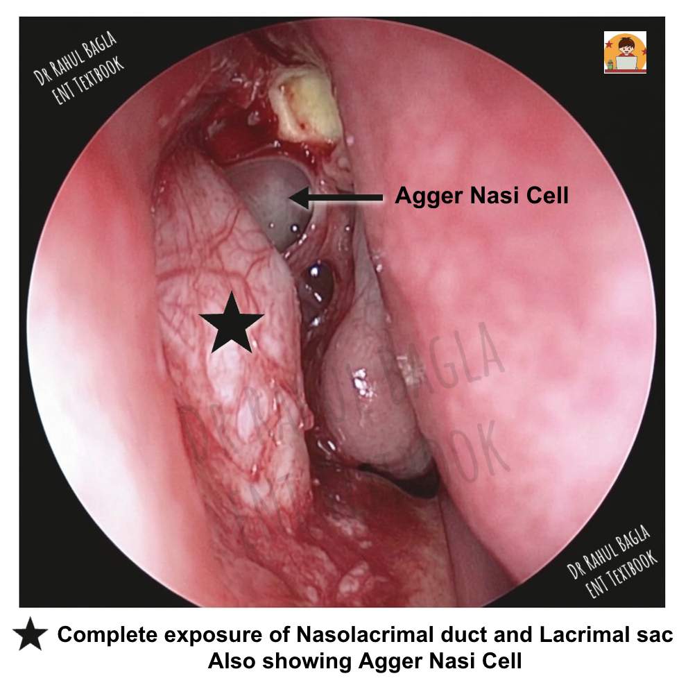 Steps of Surgery - Endoscopic DCR Complete exposure of Nasolacrimal duct and Lacrimal sac