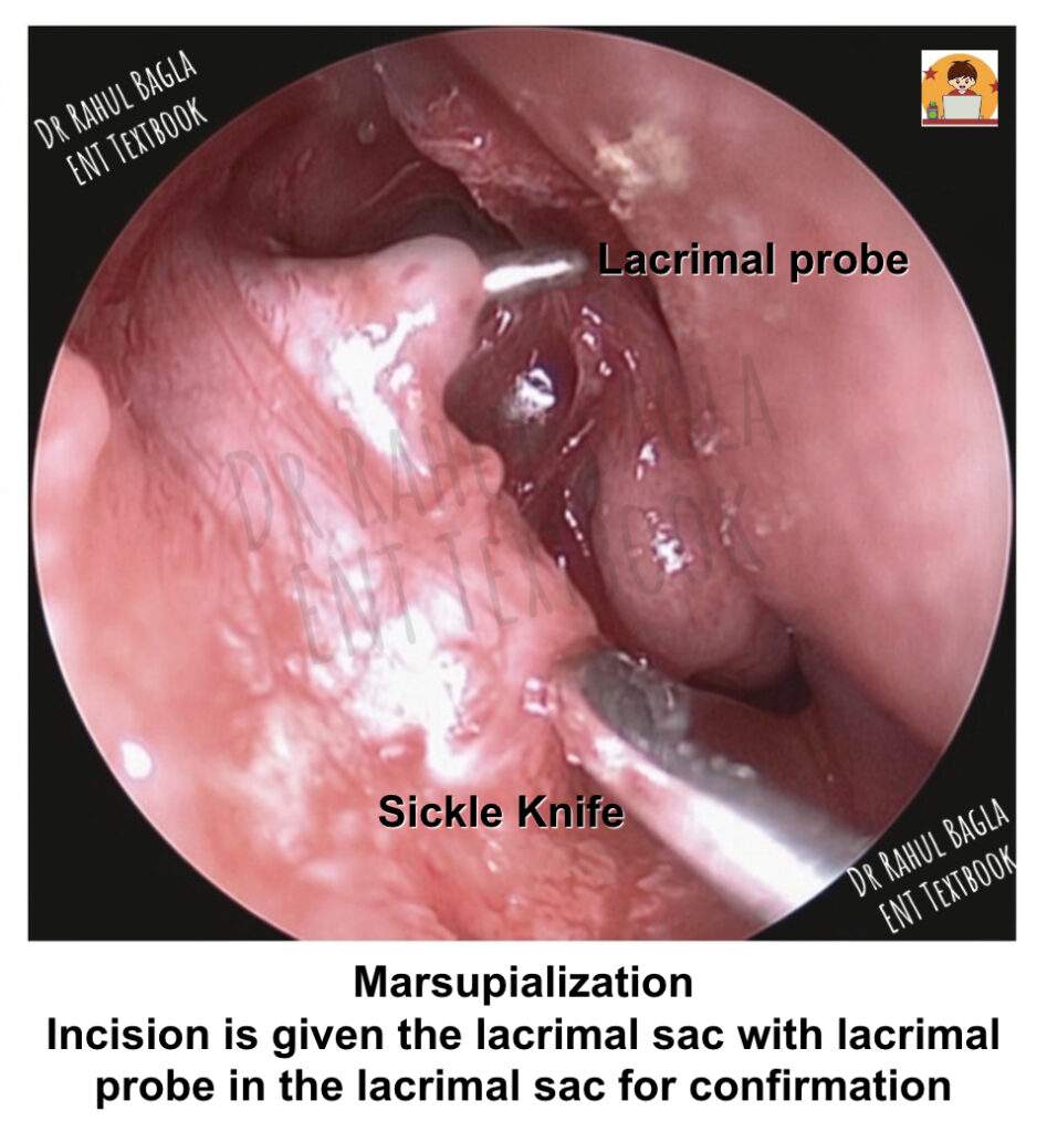 Steps of Surgery - Endoscopic DCR Marsupialization. Incision is given the lacrimal sac with lacrimal probe