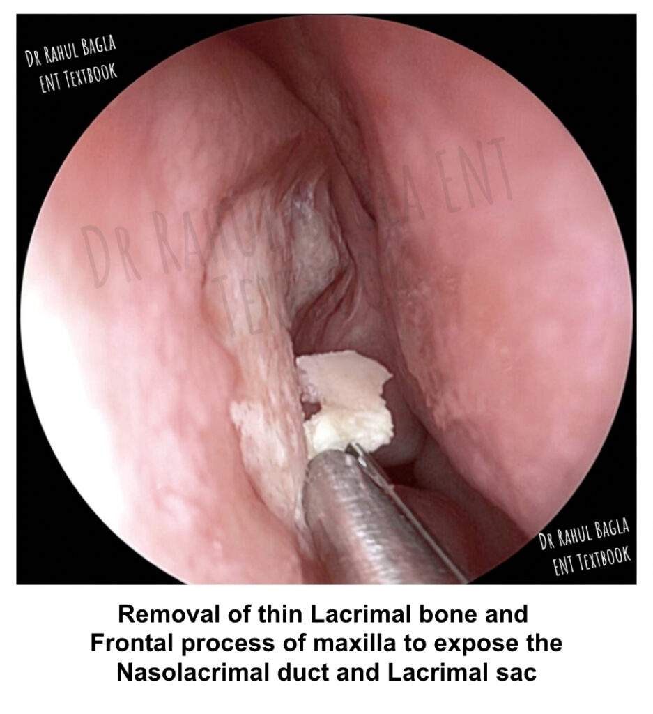 Steps of Surgery - Endoscopic DCR Removal of thin Lacrimal bone and Frontal process of maxilla