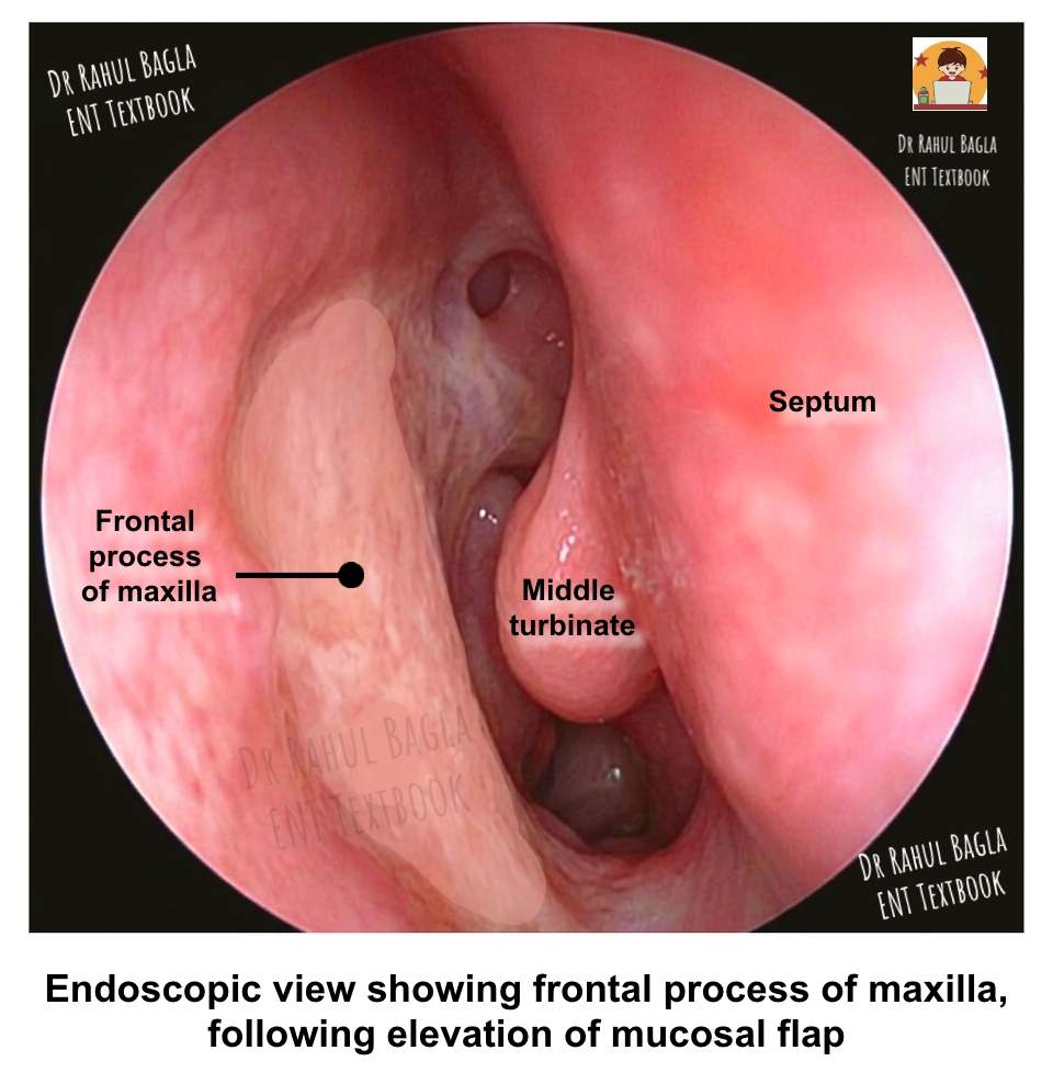 Steps-of-Surgery-of-Endoscopic-DCR-Incision 2