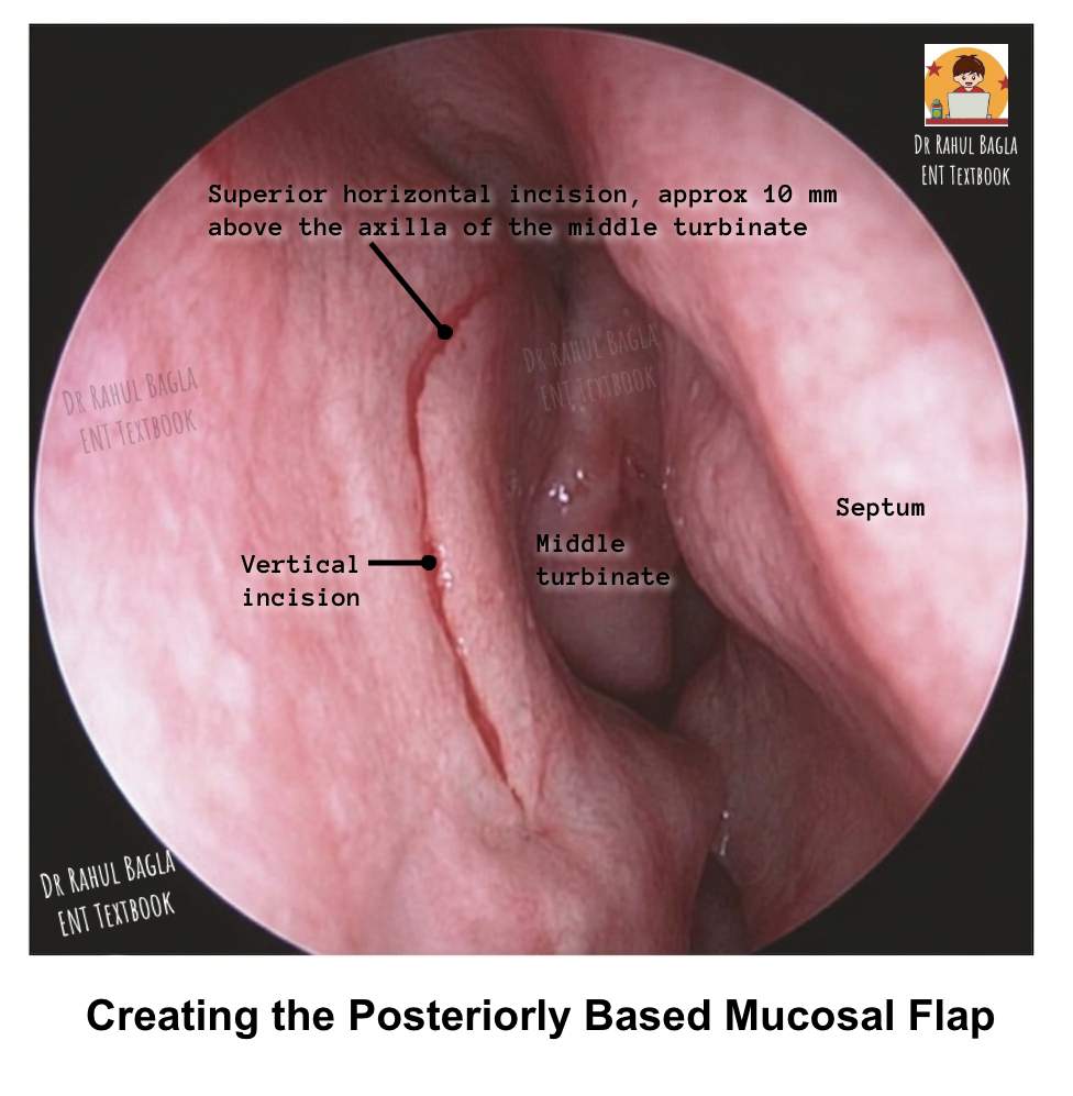 Steps of Surgery of Endoscopic DCR, Incision, Epiphora,