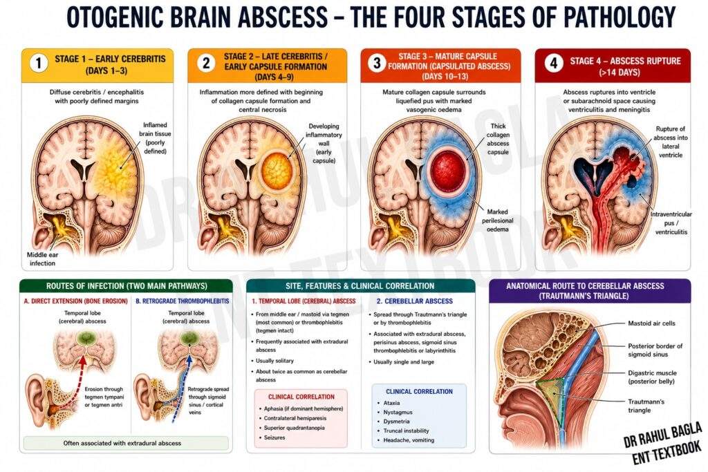 Otogenic Brain Abscess - Four Stages of Pathology