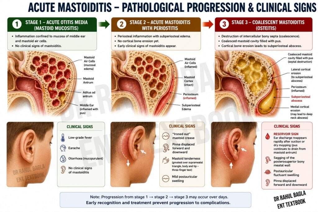 Stages of Acute Mastoiditis, light-house effect, Reservoir Sign, Dr Rahul Bagla ENT Textbook