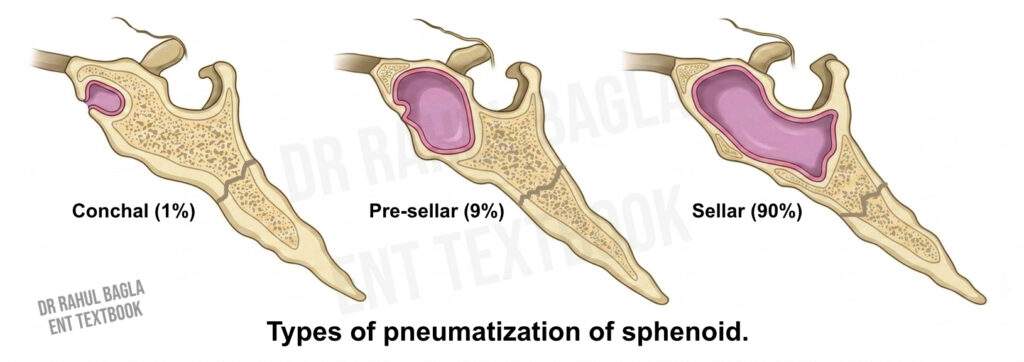 Types of pneumatization of sphenoid Sellar Presellar Conchal Dr Rahul Bagla ENT Textbook