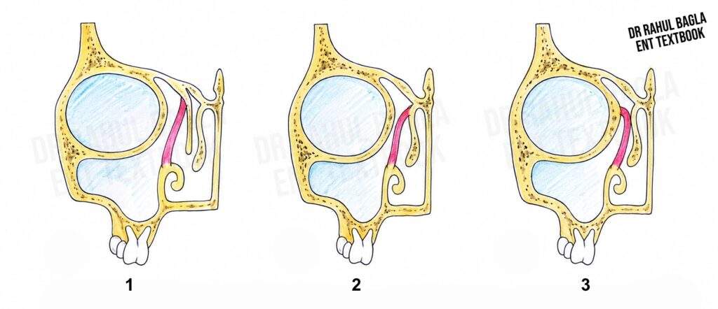 Variations in the Superior Attachment of the Uncinate Process and Their Effect on Frontal Sinus Drainage