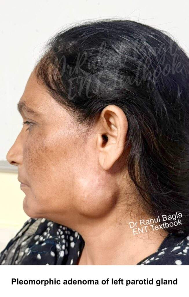 Pleomorphic adenoma of left parotid gland